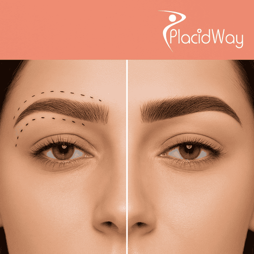 Eyebrow Hair Transplant in Turkey for Montreal Patients 